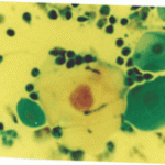 Πολυπύρηνο γιγαντιοκύτταρο. Πυρηνες με φαινόμενο ΄΄θολού γυαλιού΄'